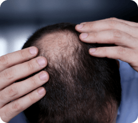 hair thinning testosterone loss